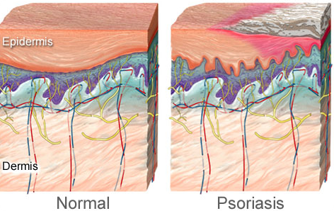پوست معمولی و سالم در کنار پوست مبتلا شده به بیماری پسوریازیس