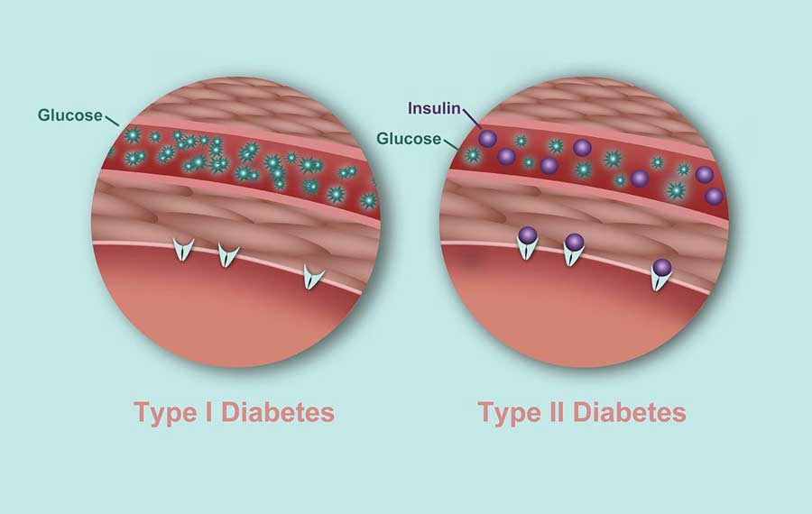 دیابت نوع 2 و 1